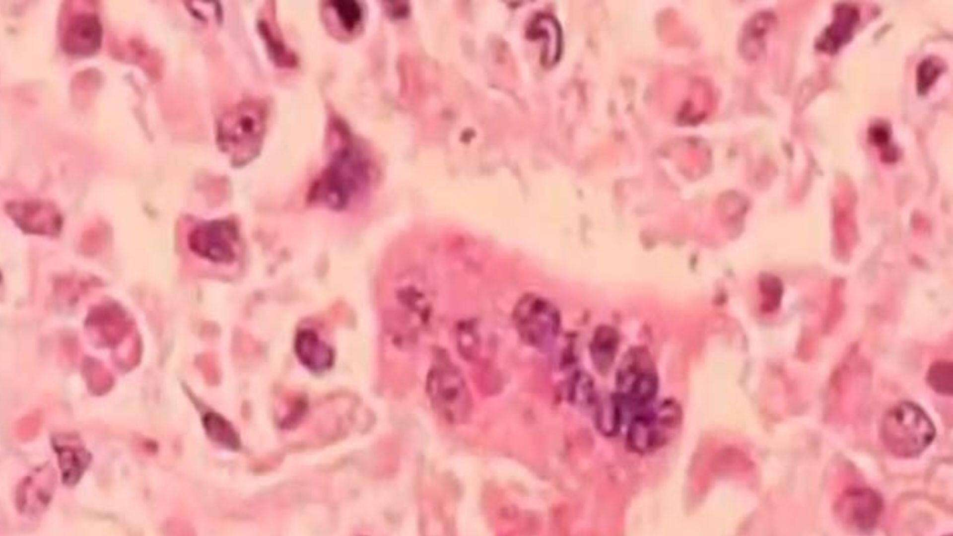 3 more measles cases confirmed in metro Atlanta daycare outbreak