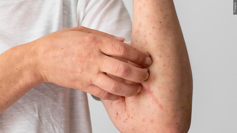 FILE: Skin rash seen after a measles contamination.